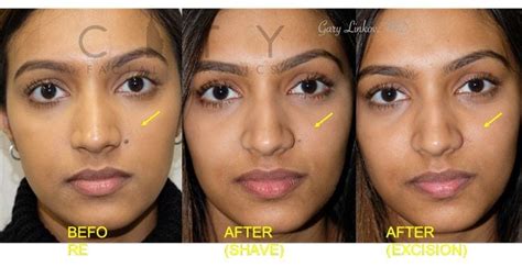 facial mole removal plastic surgeon.